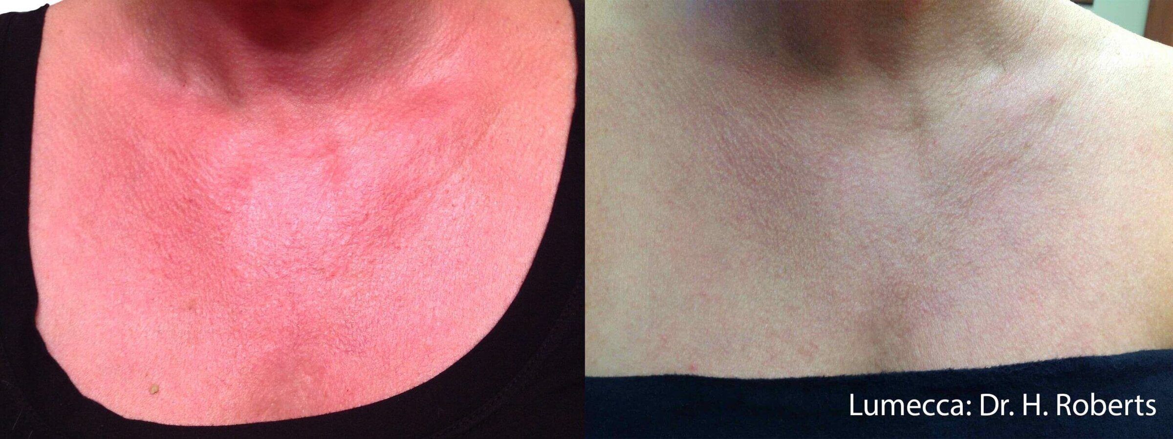 Lumecca IPL Body before and after