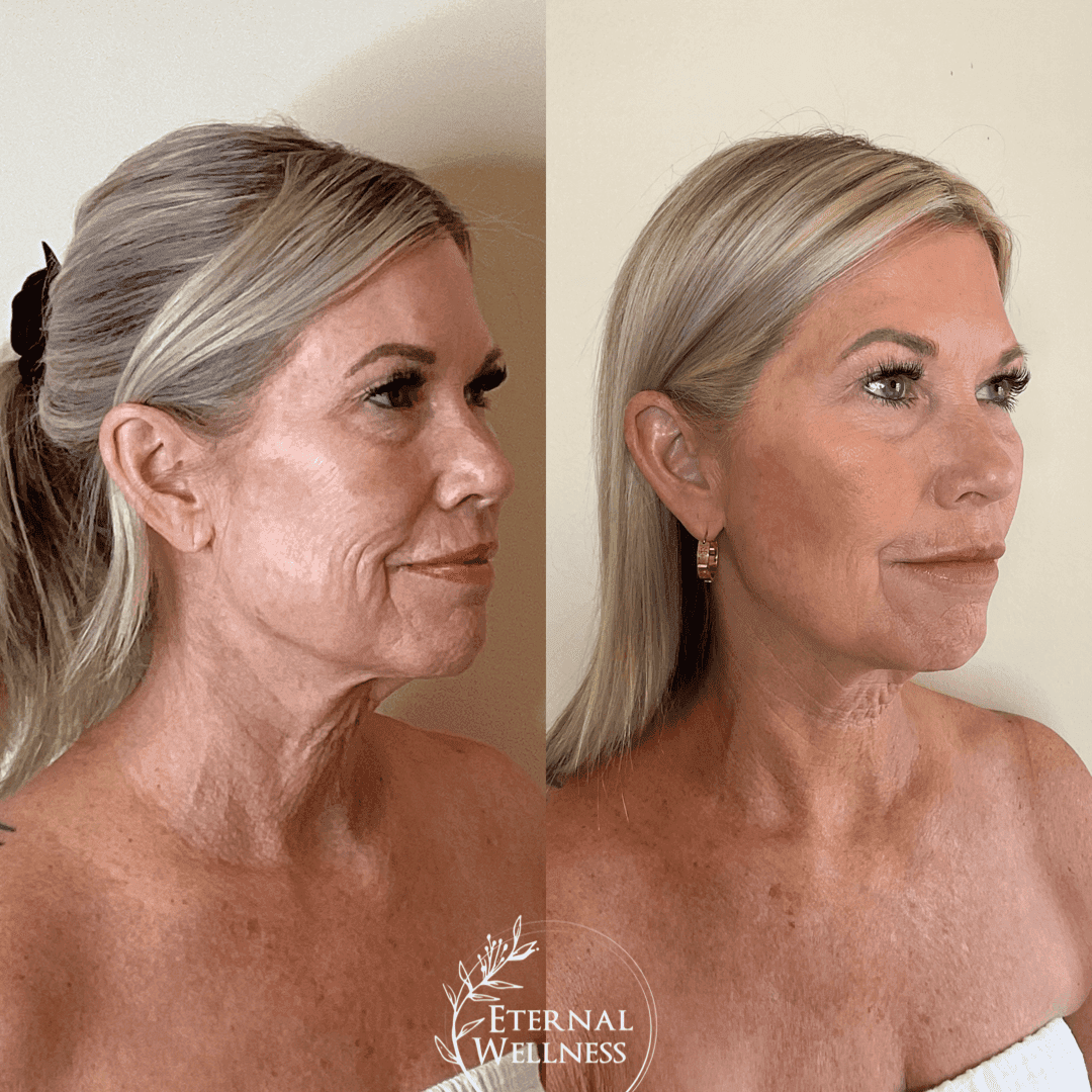 Morpheus8 Face before and after