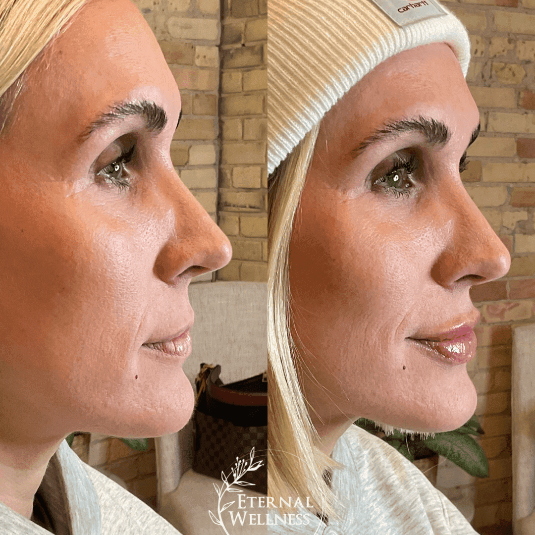 Restylane before and after