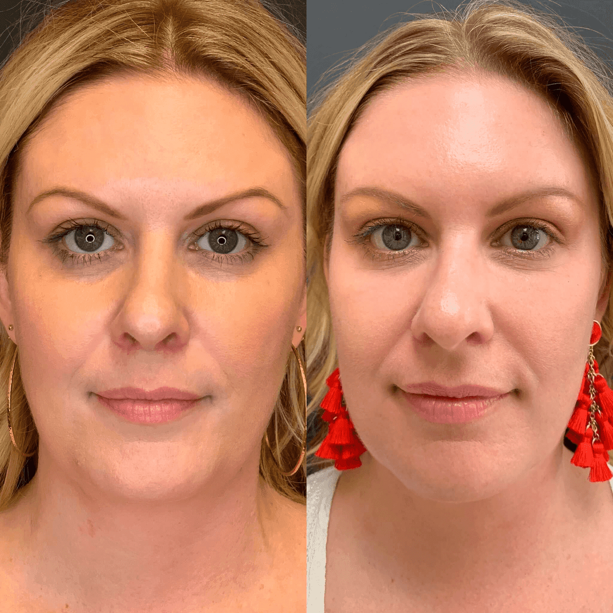 PRP & PRF before and after