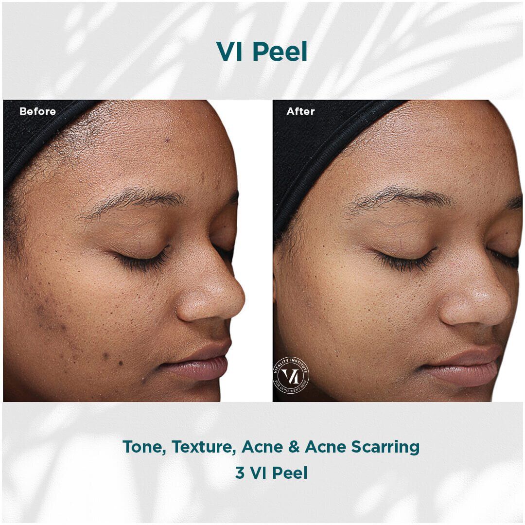 VI Chemical Peel before and after