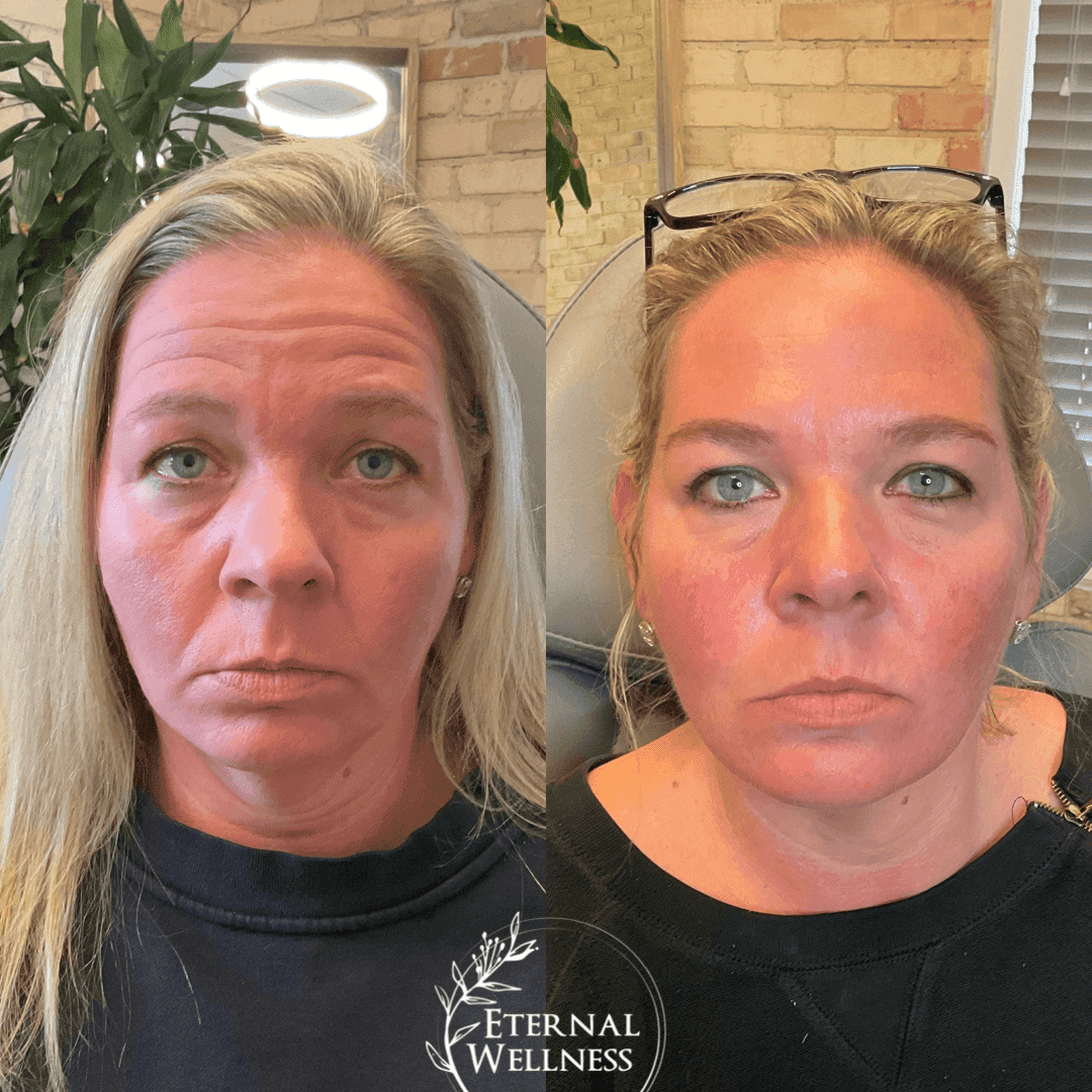 Dysport before and after