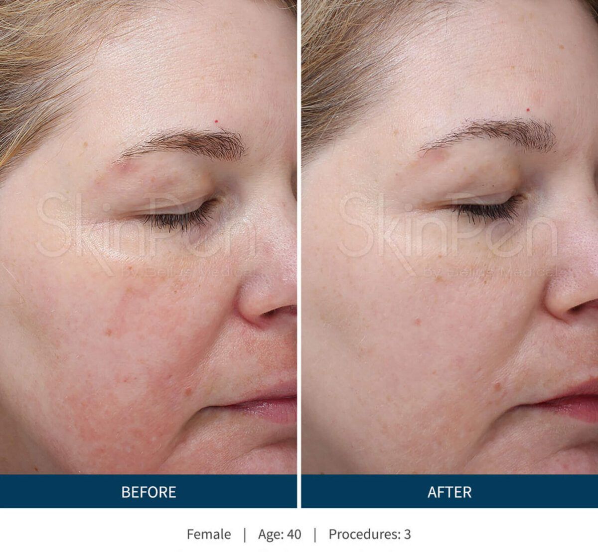 SkinPen before and after