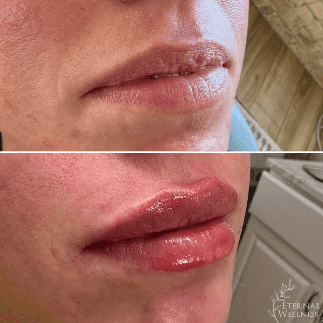 Lip Injections before and after