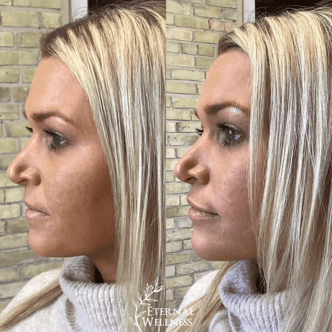 Dermal Fillers before and after