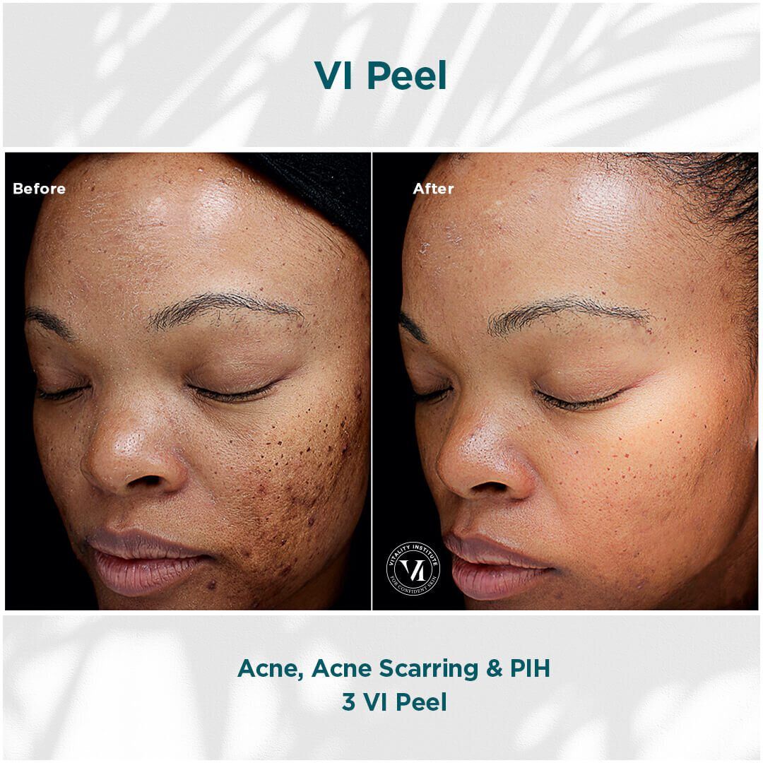 VI Chemical Peel before and after