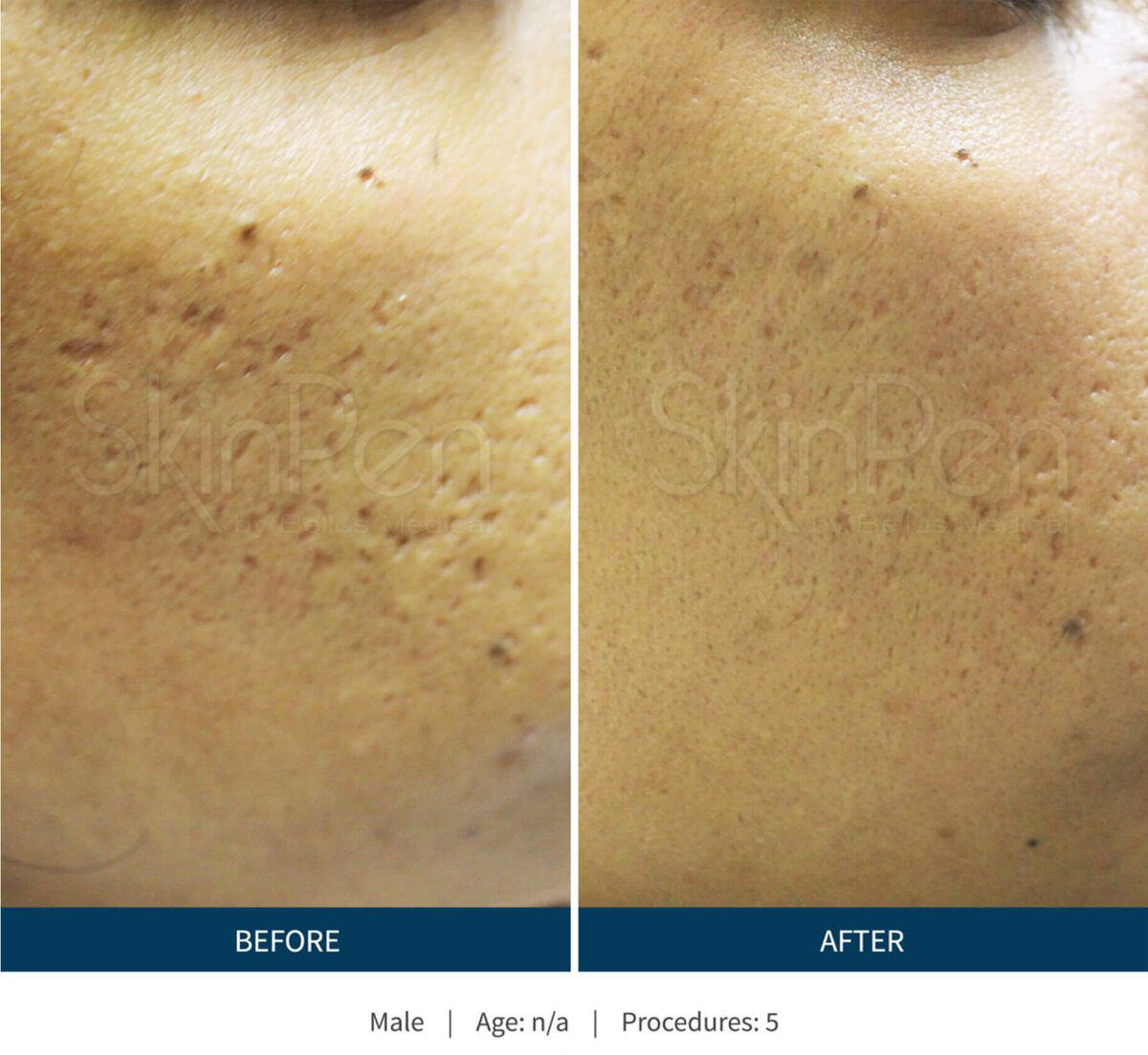 SkinPen before and after