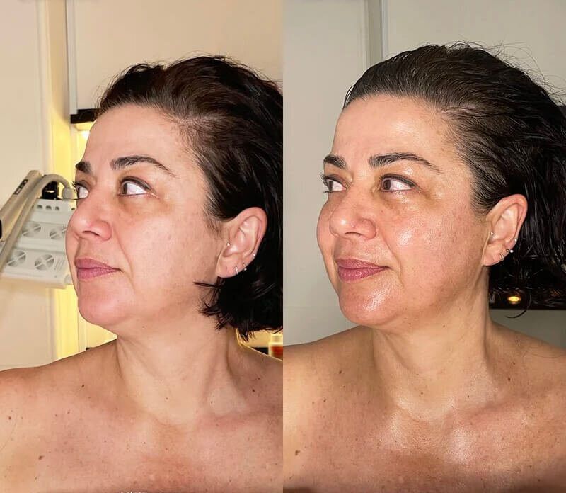 Lymphatic Drainage before and after