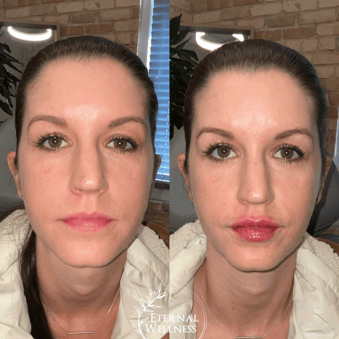 Restylane before and after