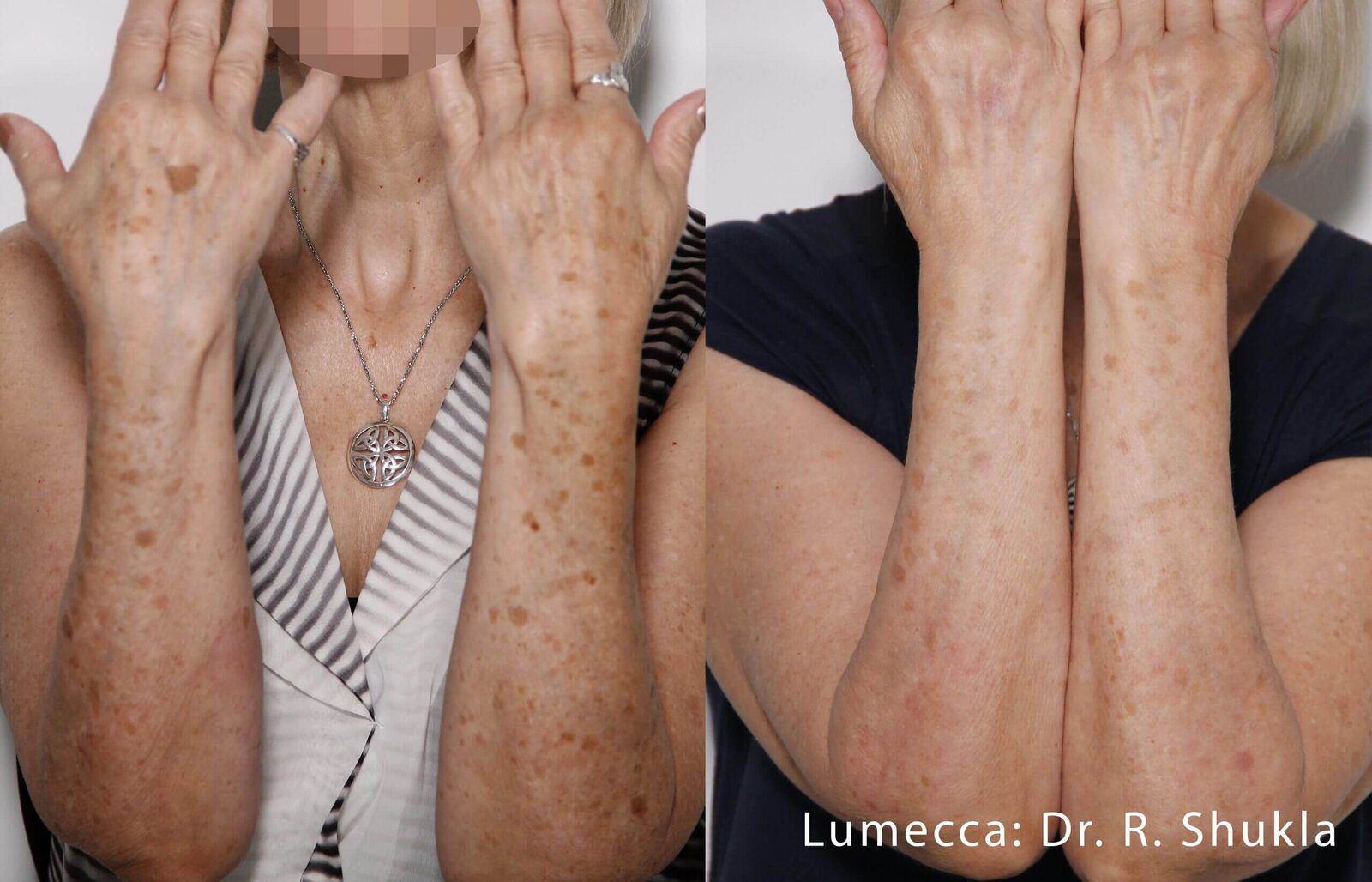 Lumecca IPL Body before and after