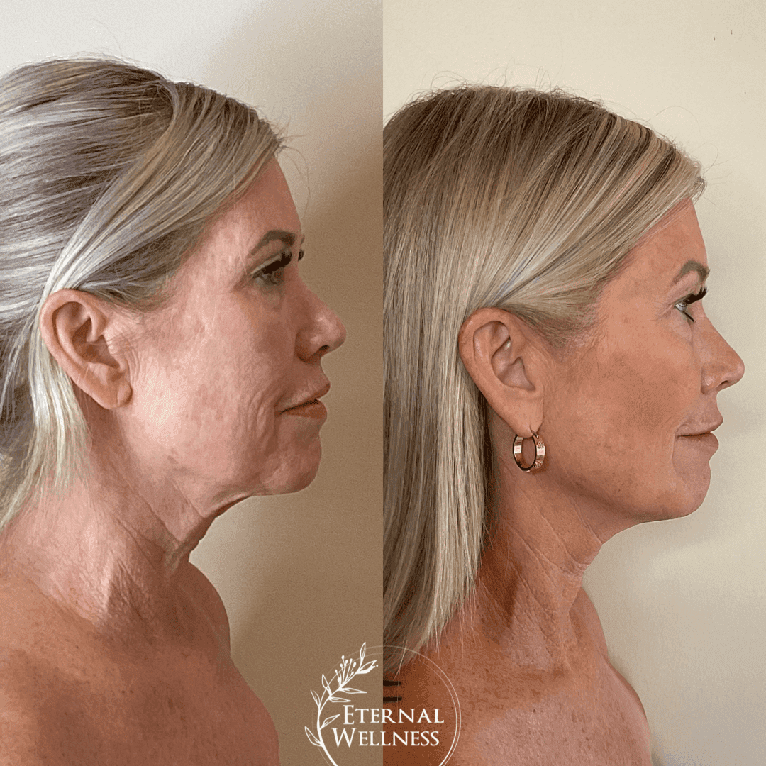 Morpheus8 Face before and after