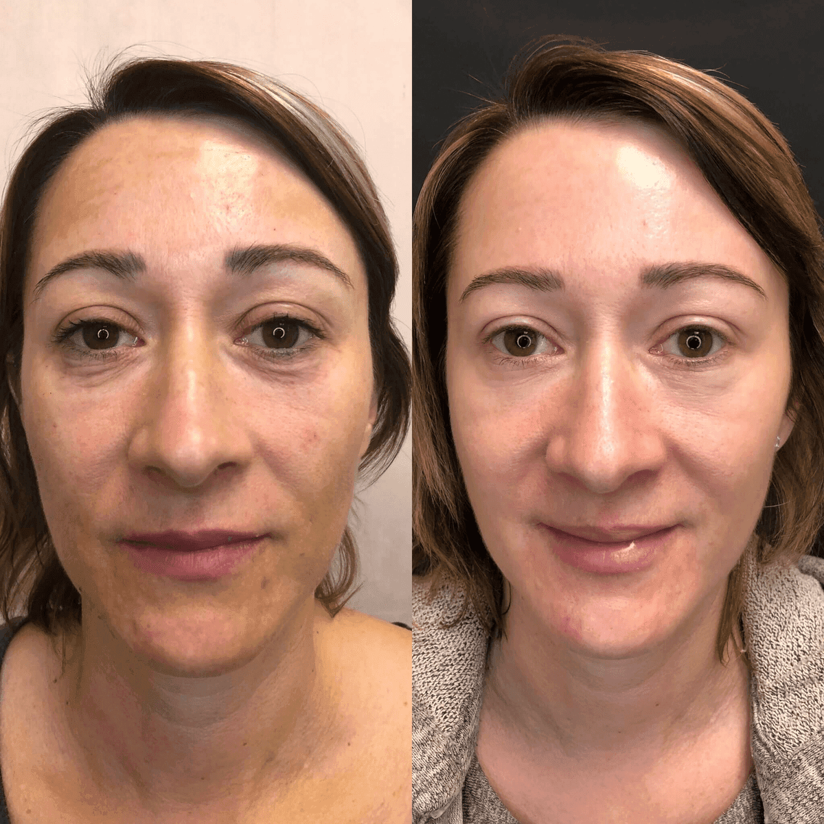 PRP & PRF before and after