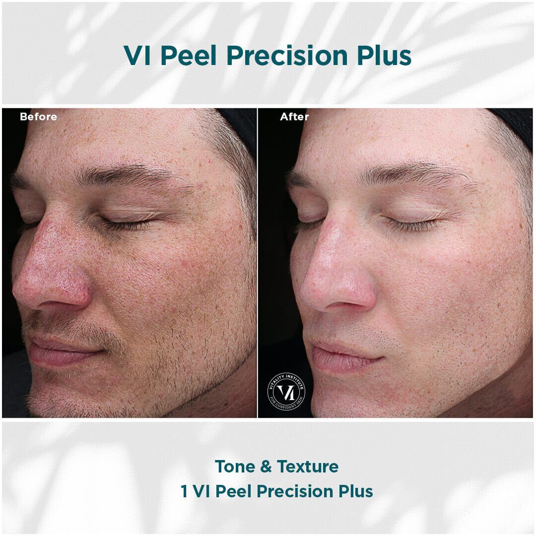 VI Chemical Peel before and after