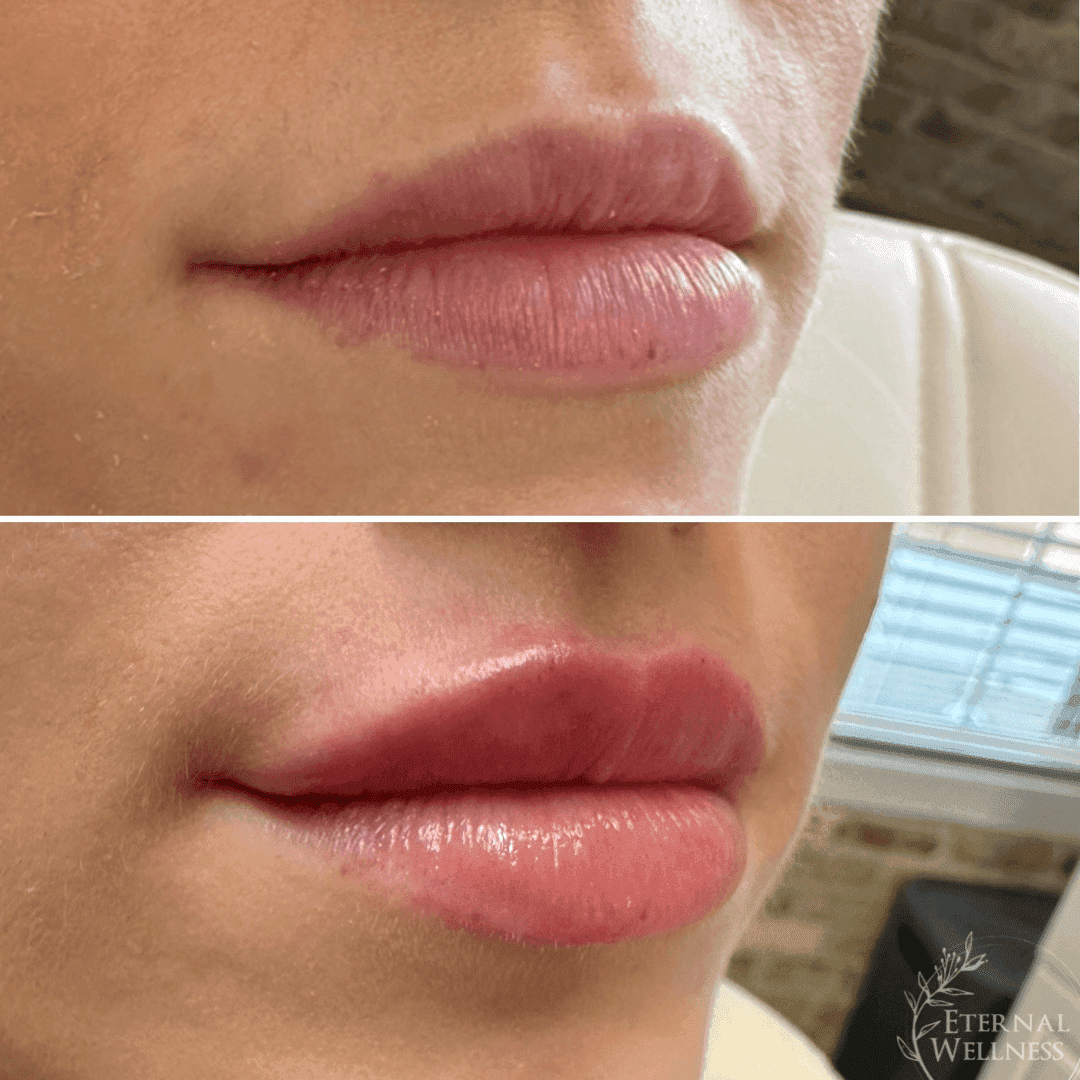 Lip Injections before and after