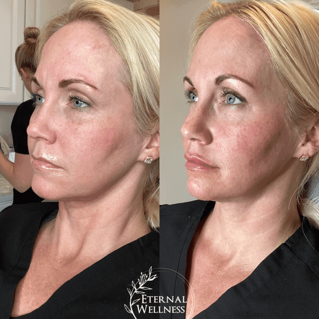 Dermal Fillers before and after