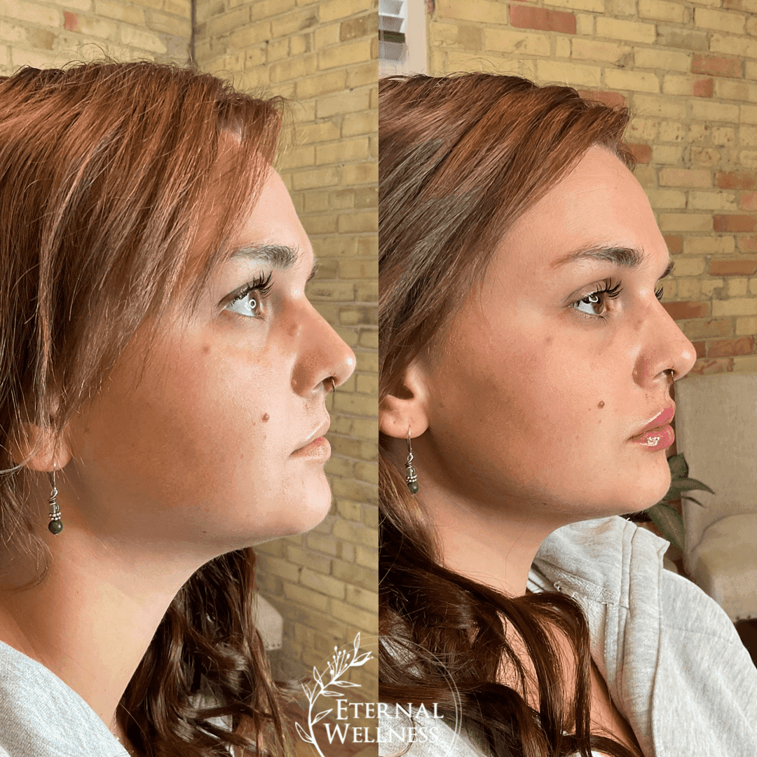 Restylane before and after