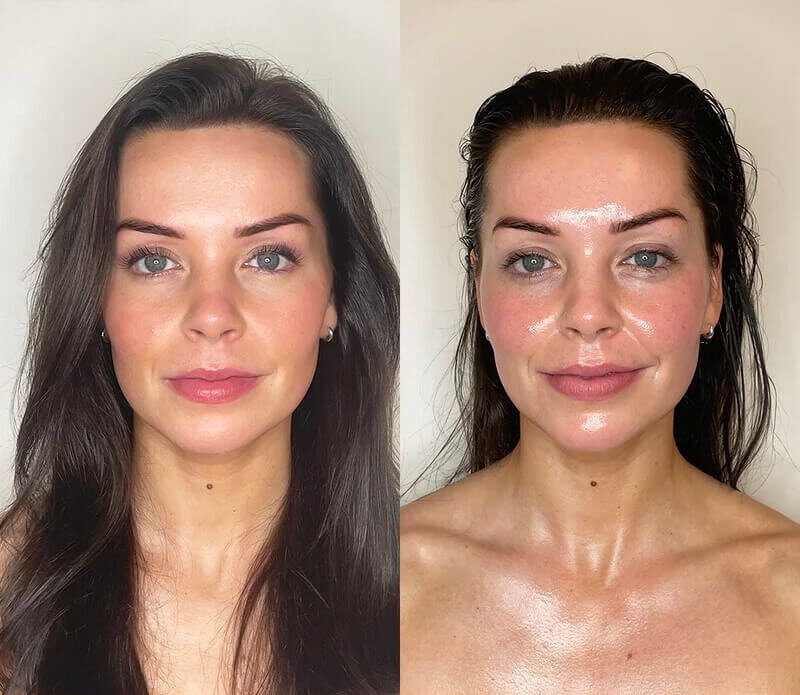 Lymphatic Drainage before and after