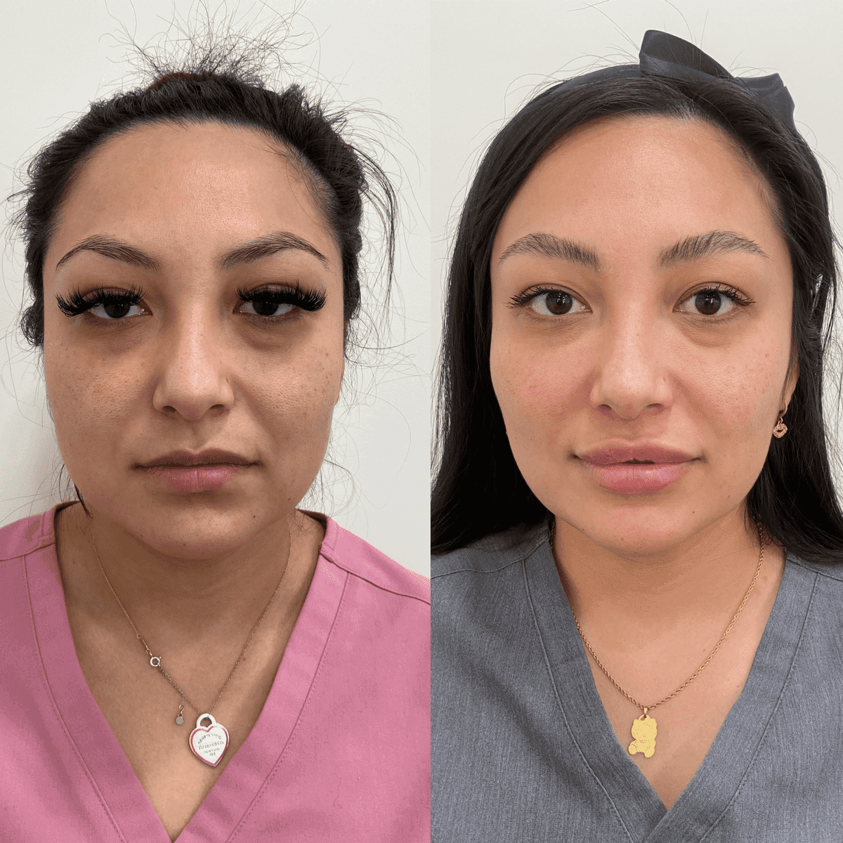 PRP & PRF before and after
