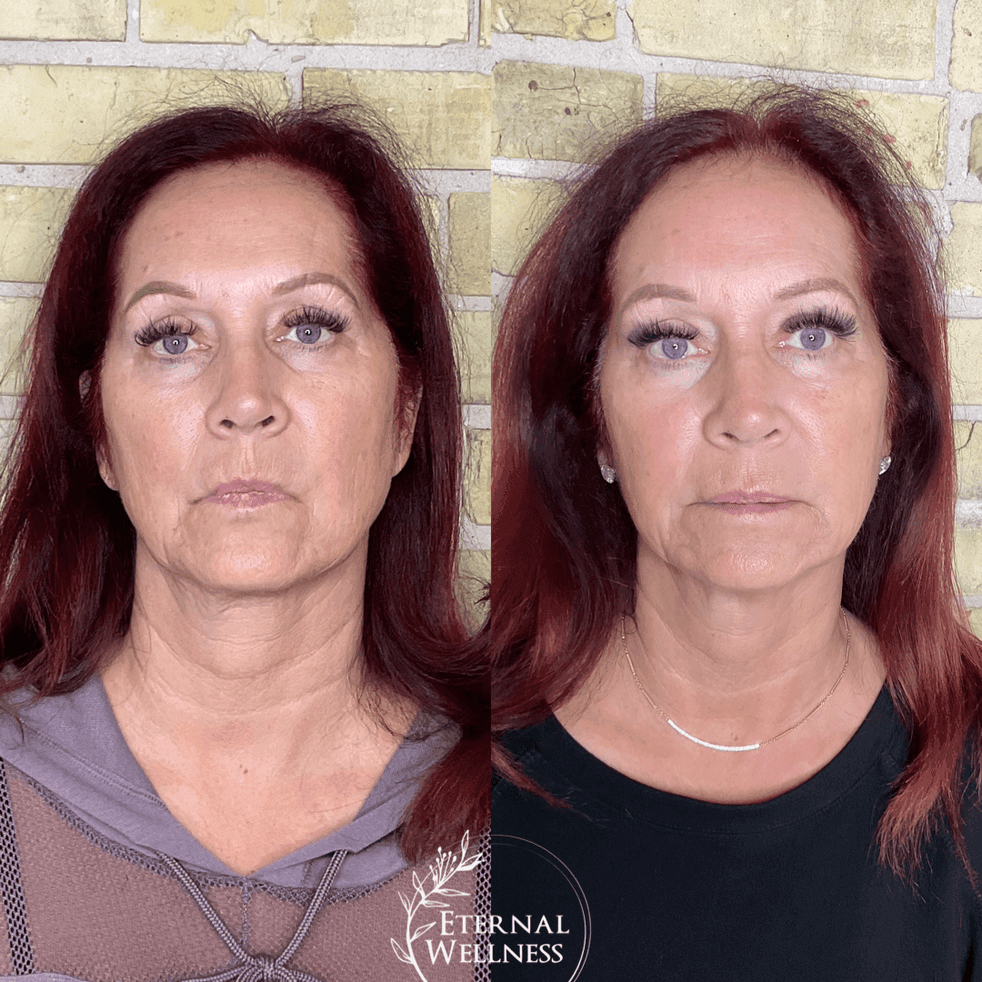 Morpheus8 Face before and after