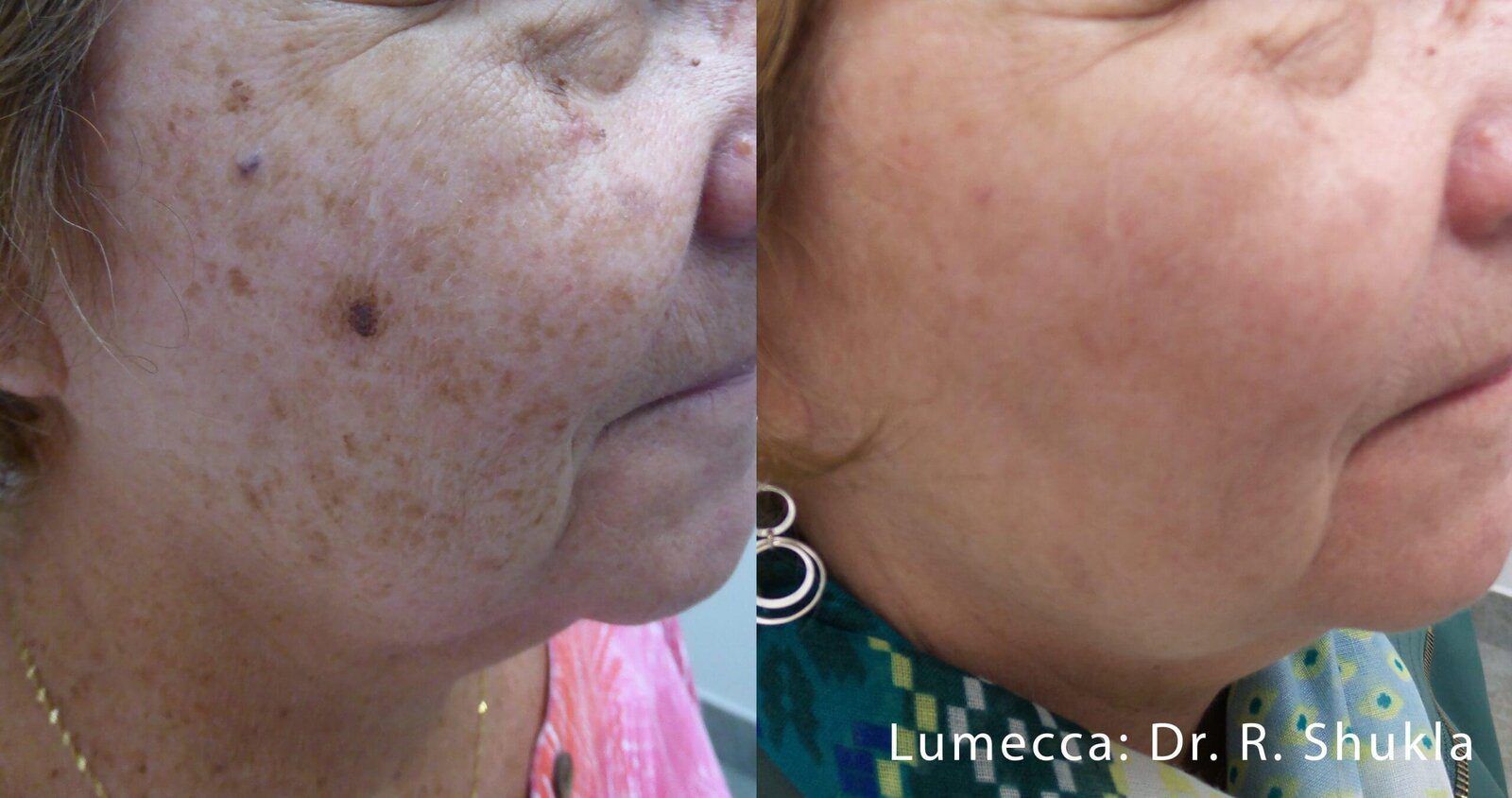Lumecca IPL Face before and after