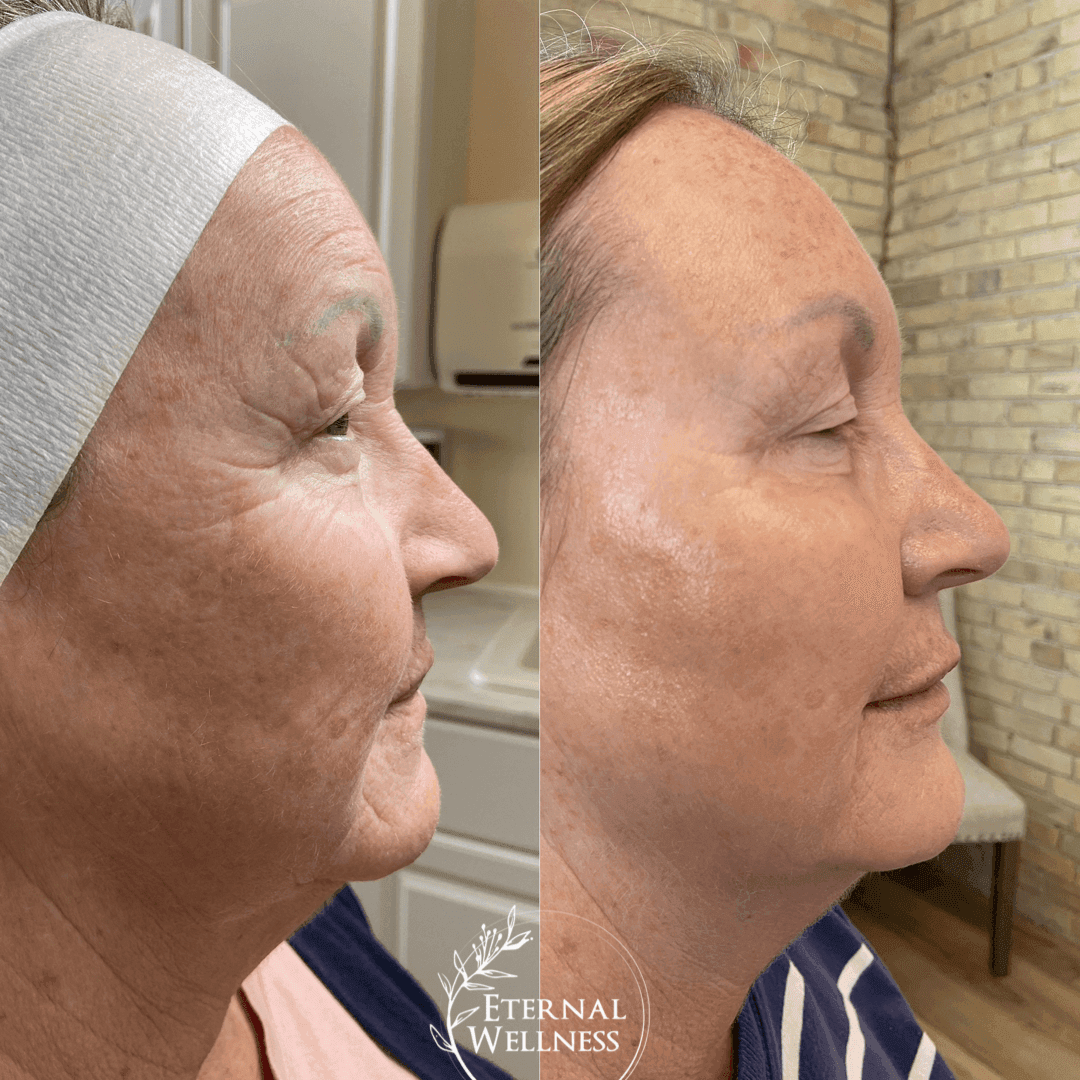 Dermal Fillers before and after