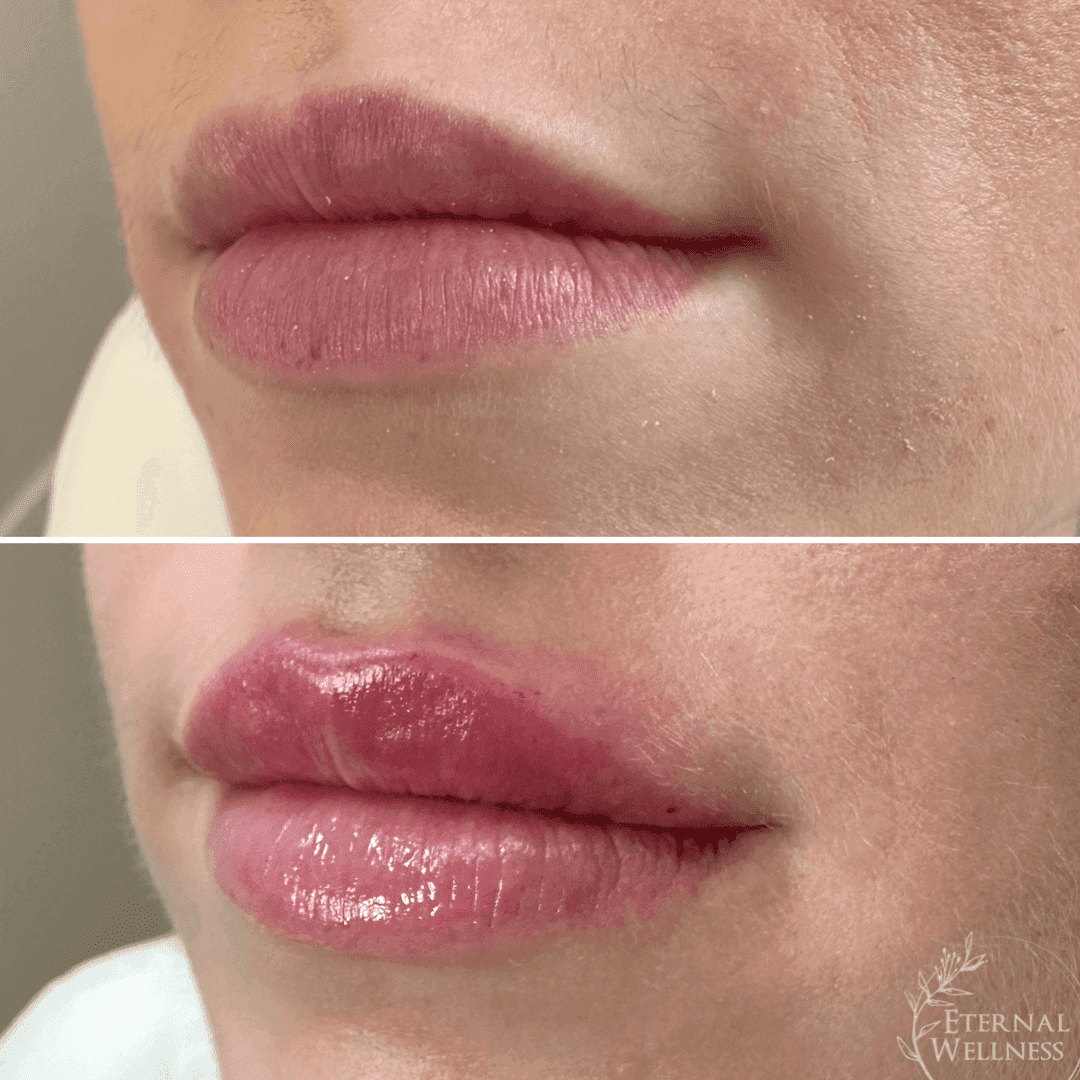 Restylane before and after