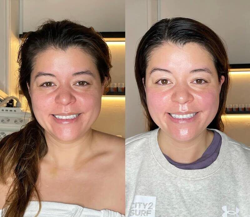 Lymphatic Drainage before and after