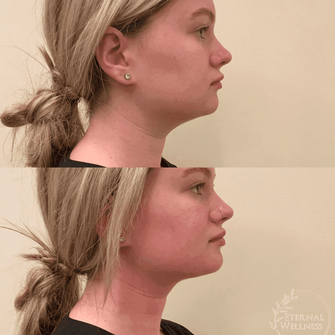 Forma RF before and after