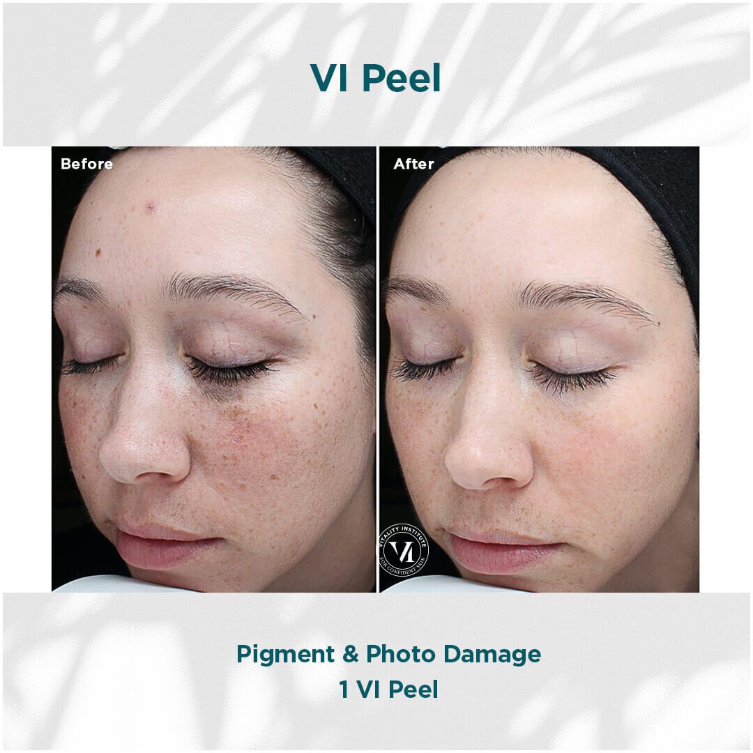 VI Chemical Peel before and after