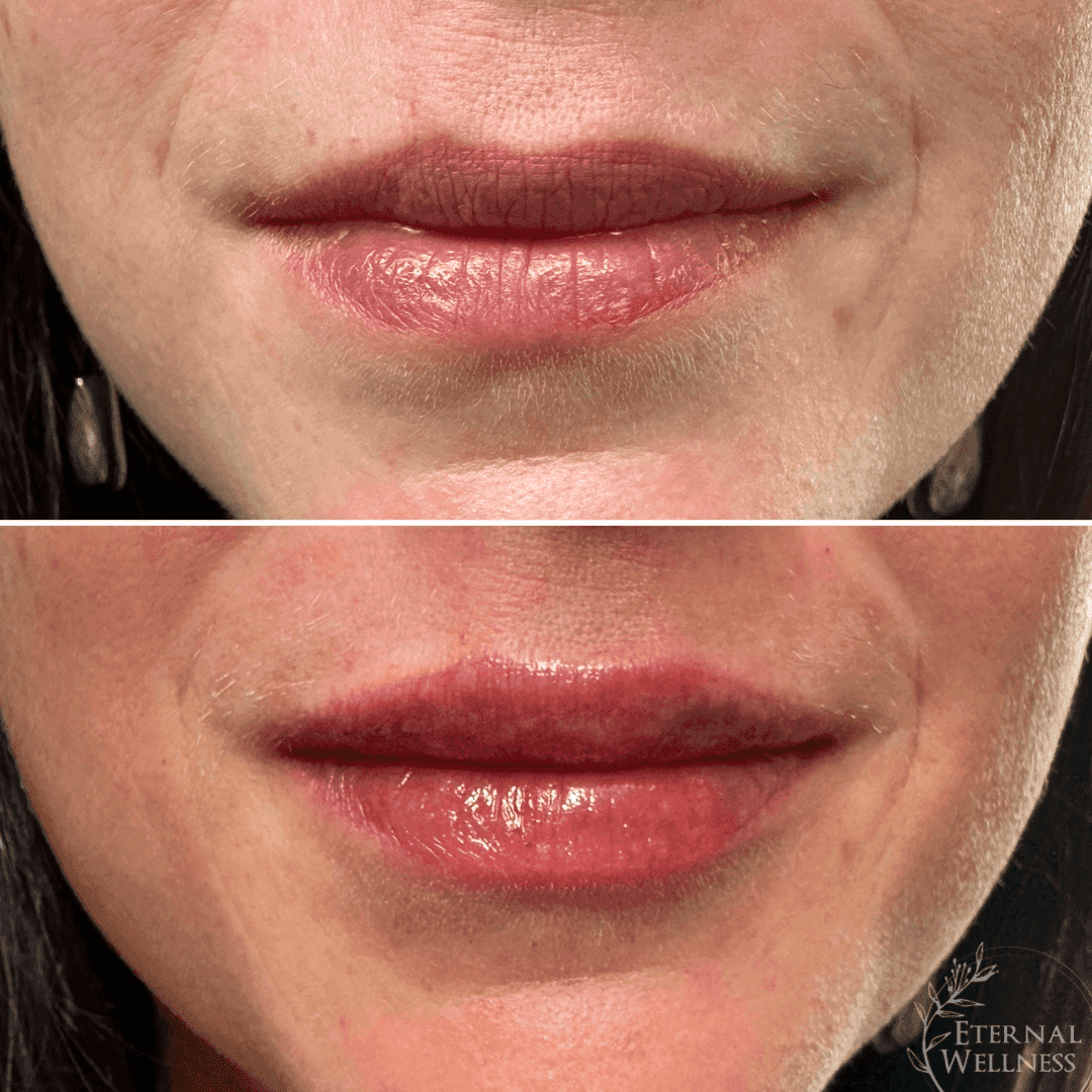 Lip Injections before and after