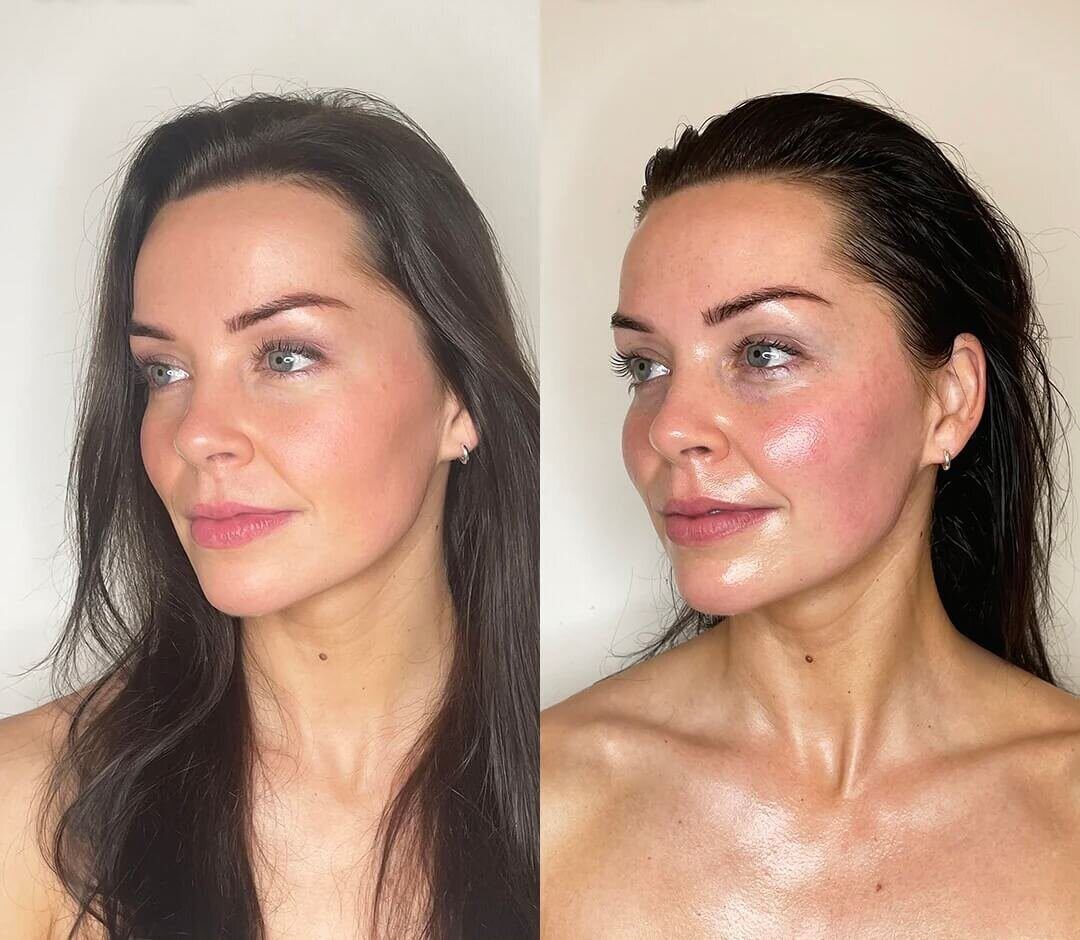 Lymphatic Drainage before and after