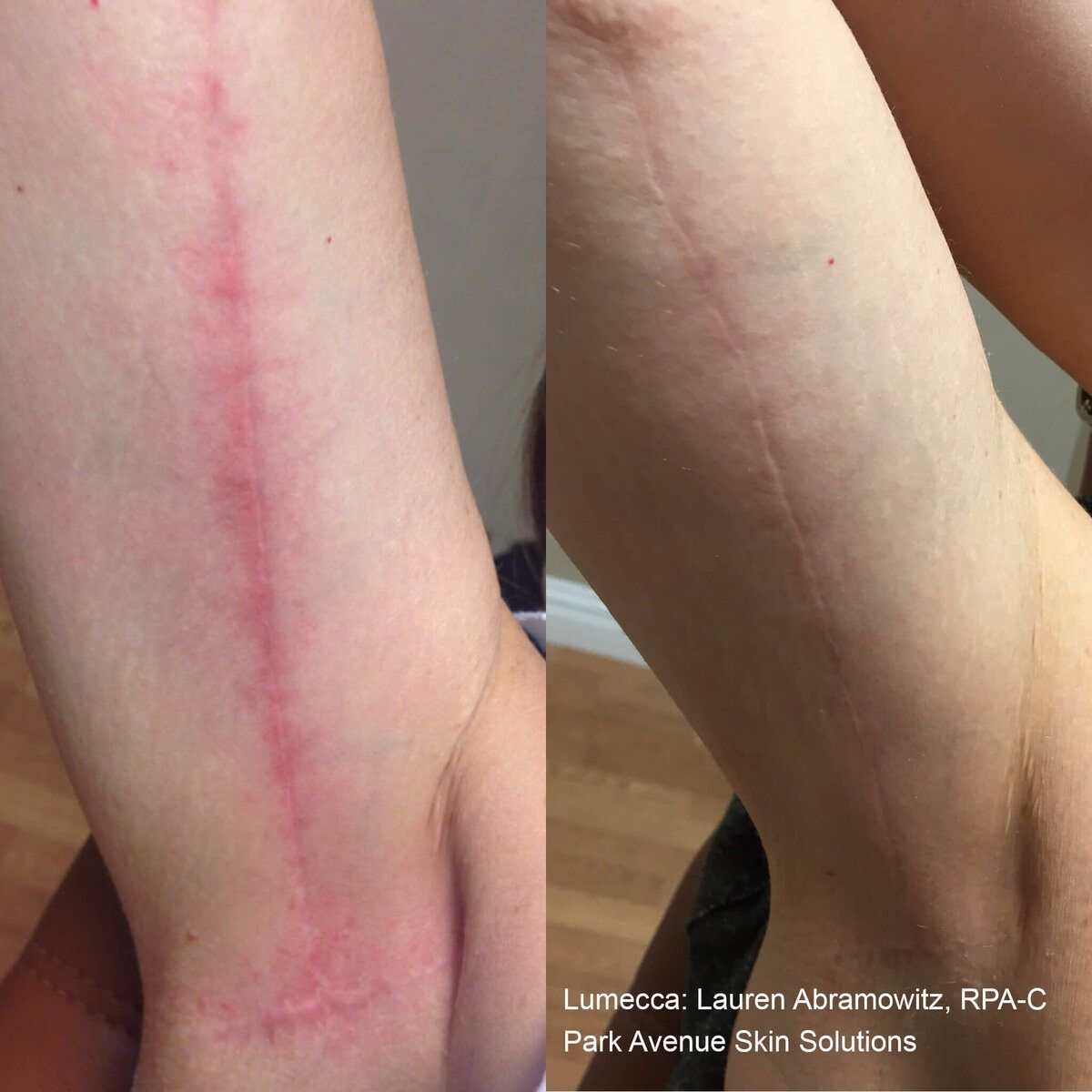 Lumecca IPL Body before and after