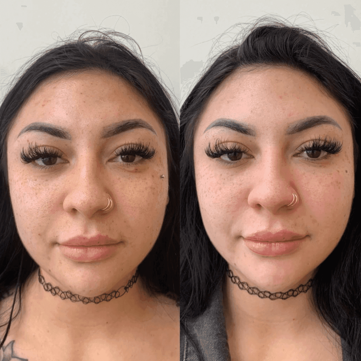 PRP & PRF before and after