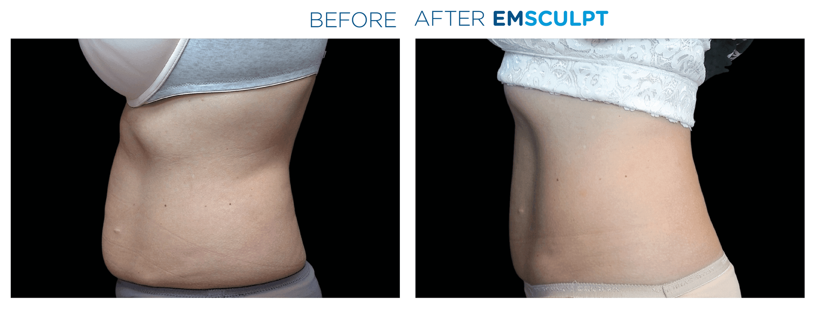 Emsculpt in Crescent Springs before and after