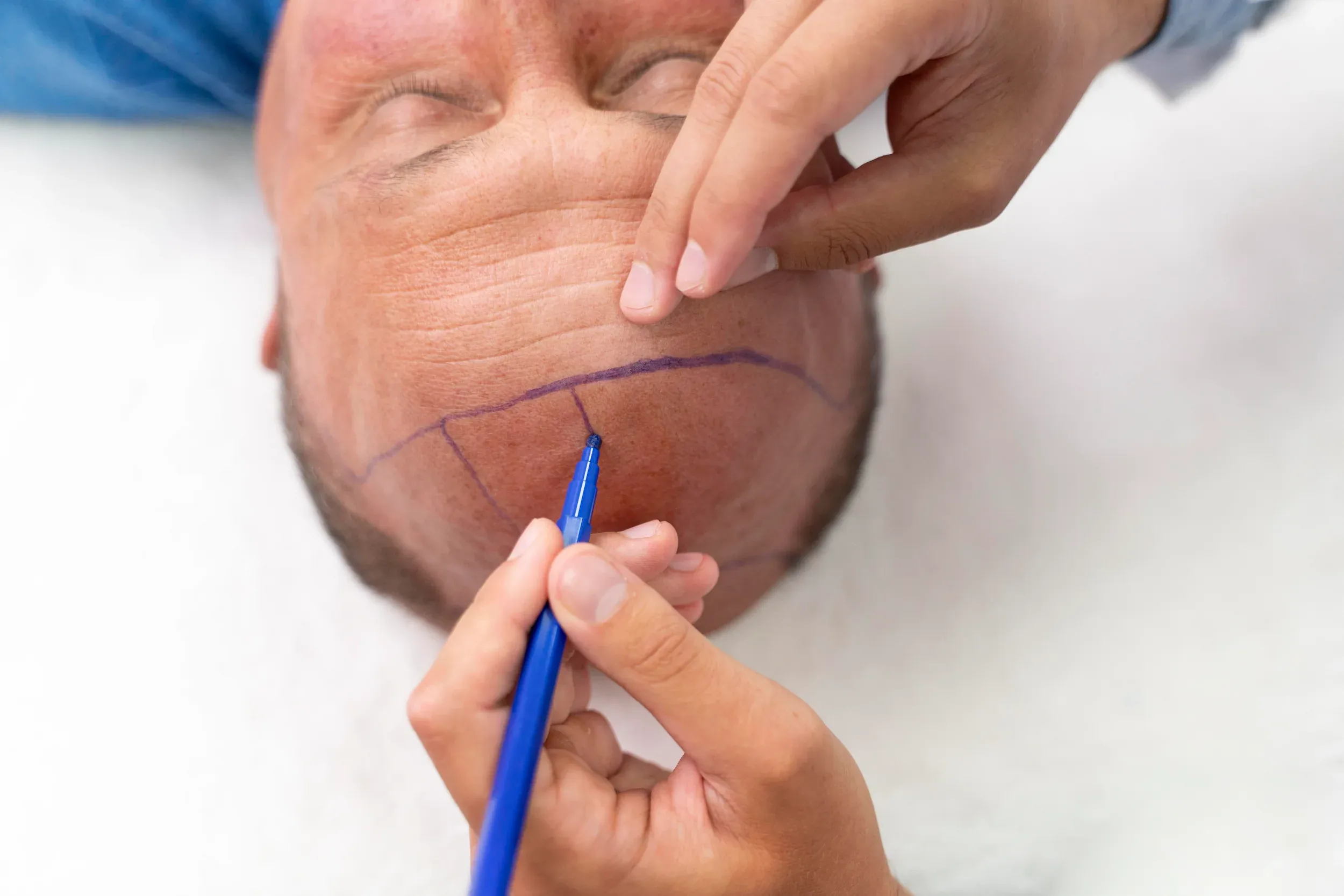 Board-certified dermatologist examining a patient's scalp to estimate hair transplant graft count at DSI Hair in Algonquin Illinois
