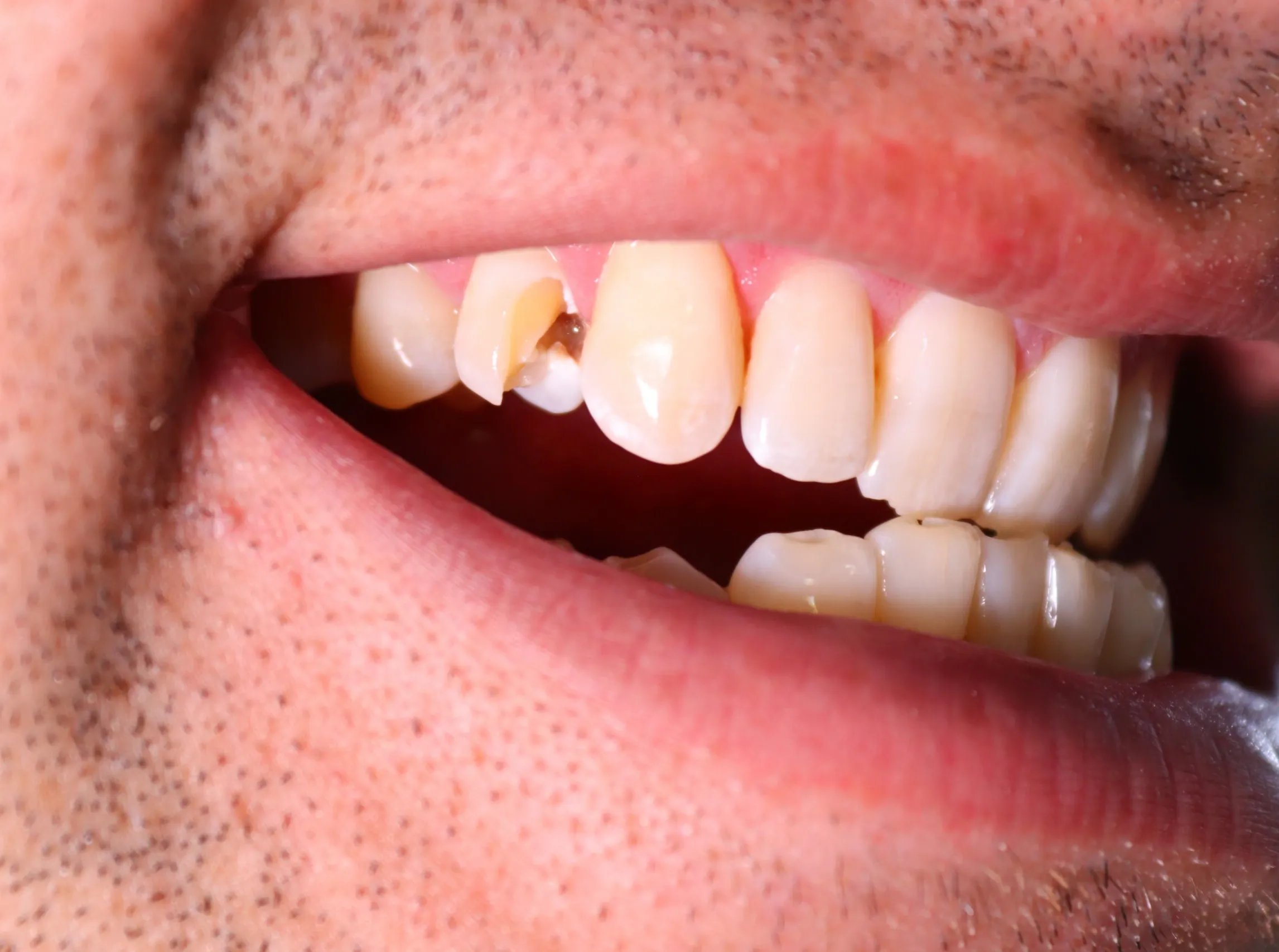 Patient describing how a tooth broke during a sports activity