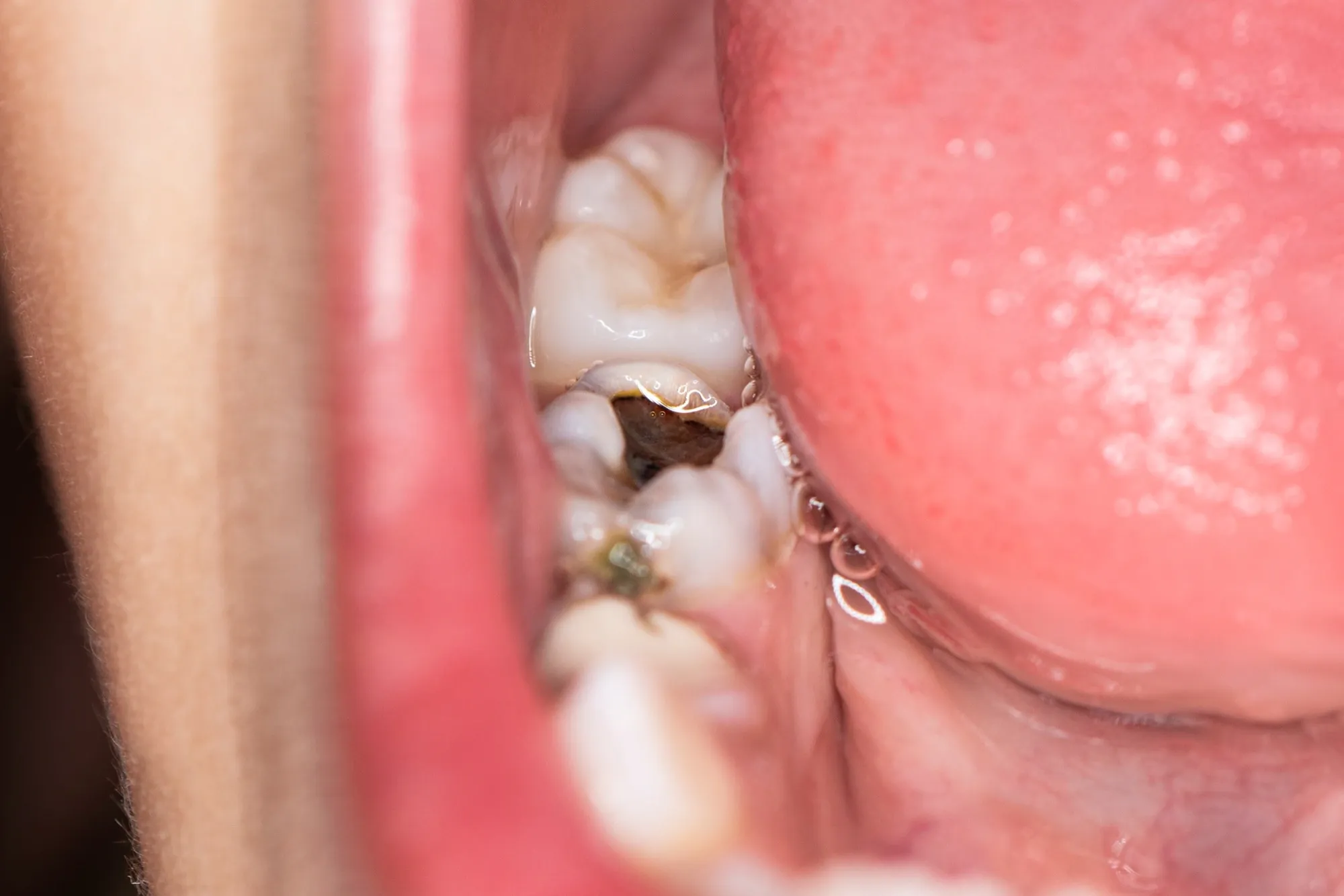 Dentist using digital X-ray to detect early cavity at Enclave Dental Lake Mary