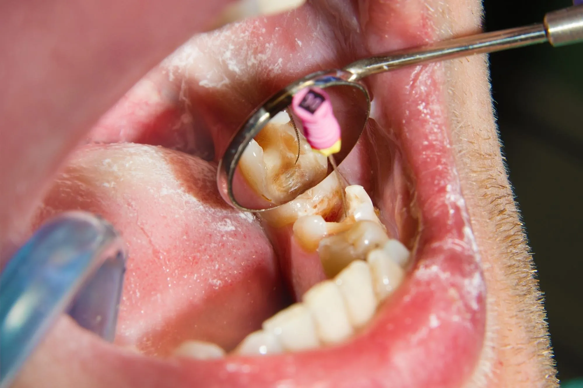 Illustration of bacteria causing acid demineralization on tooth enamel