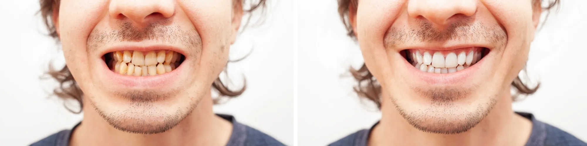 Clear Aligners - Before and After