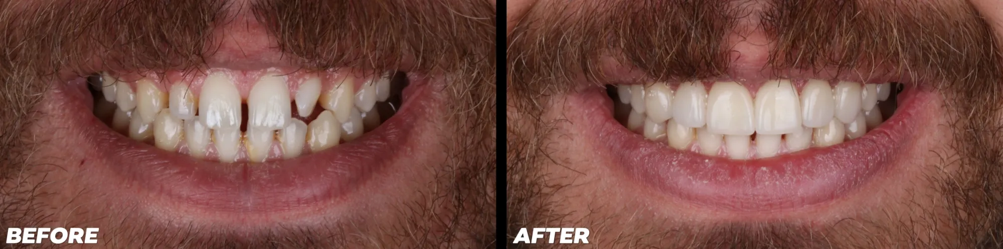 Clear Aligners - Before and After