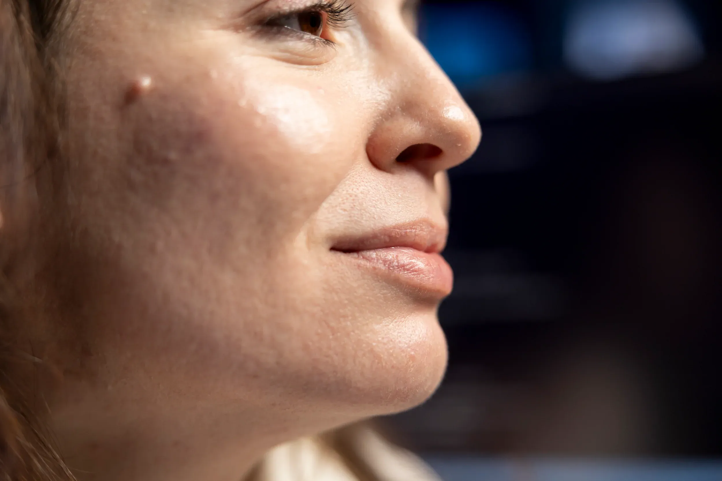 Lifestyle factors affecting acne at Mint Aesthetics & Skin Indianapolis