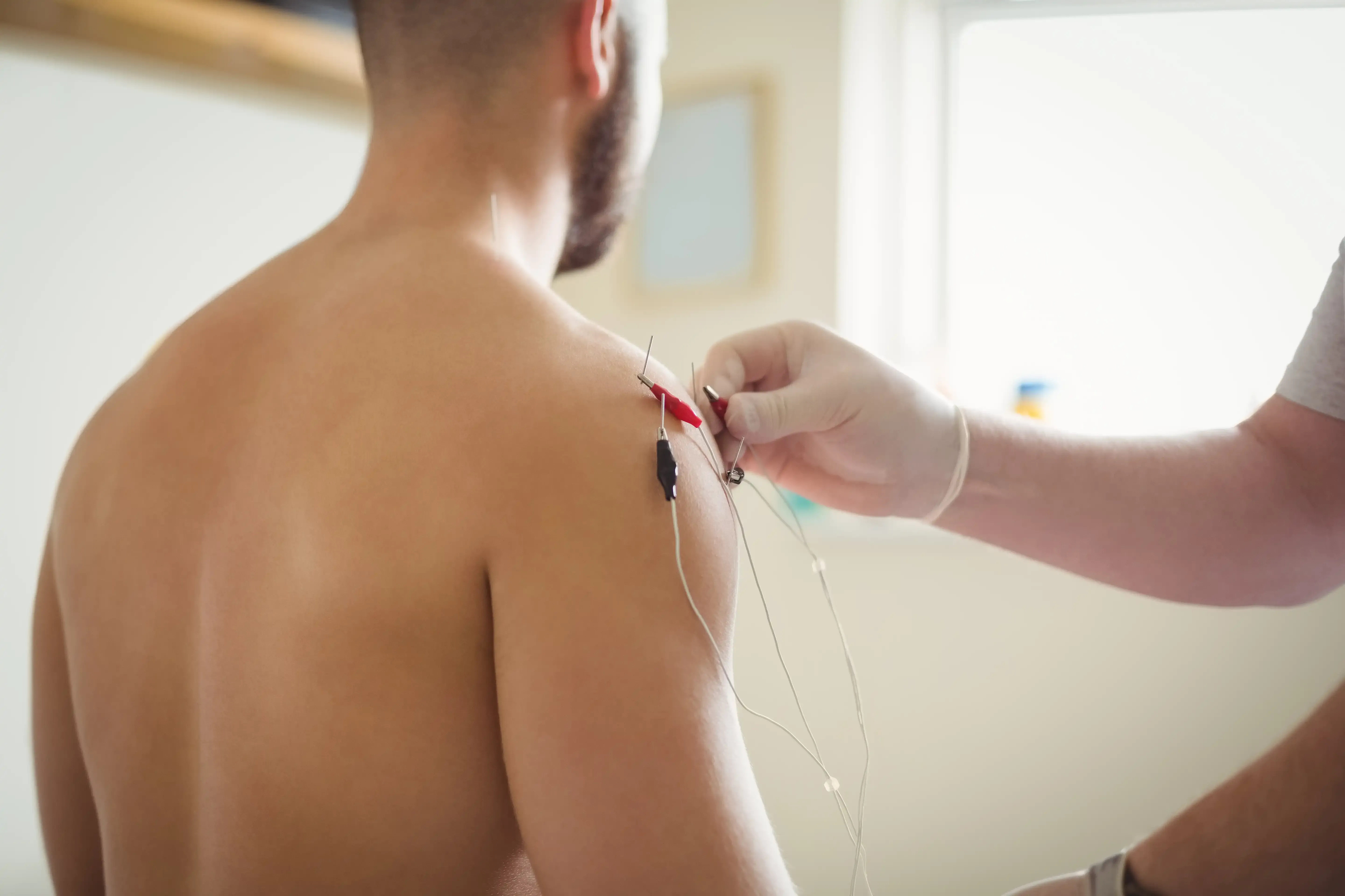 Dry needling treatment at Spine-Ability Chiropractic and Wellness in Apollo Beach, FL