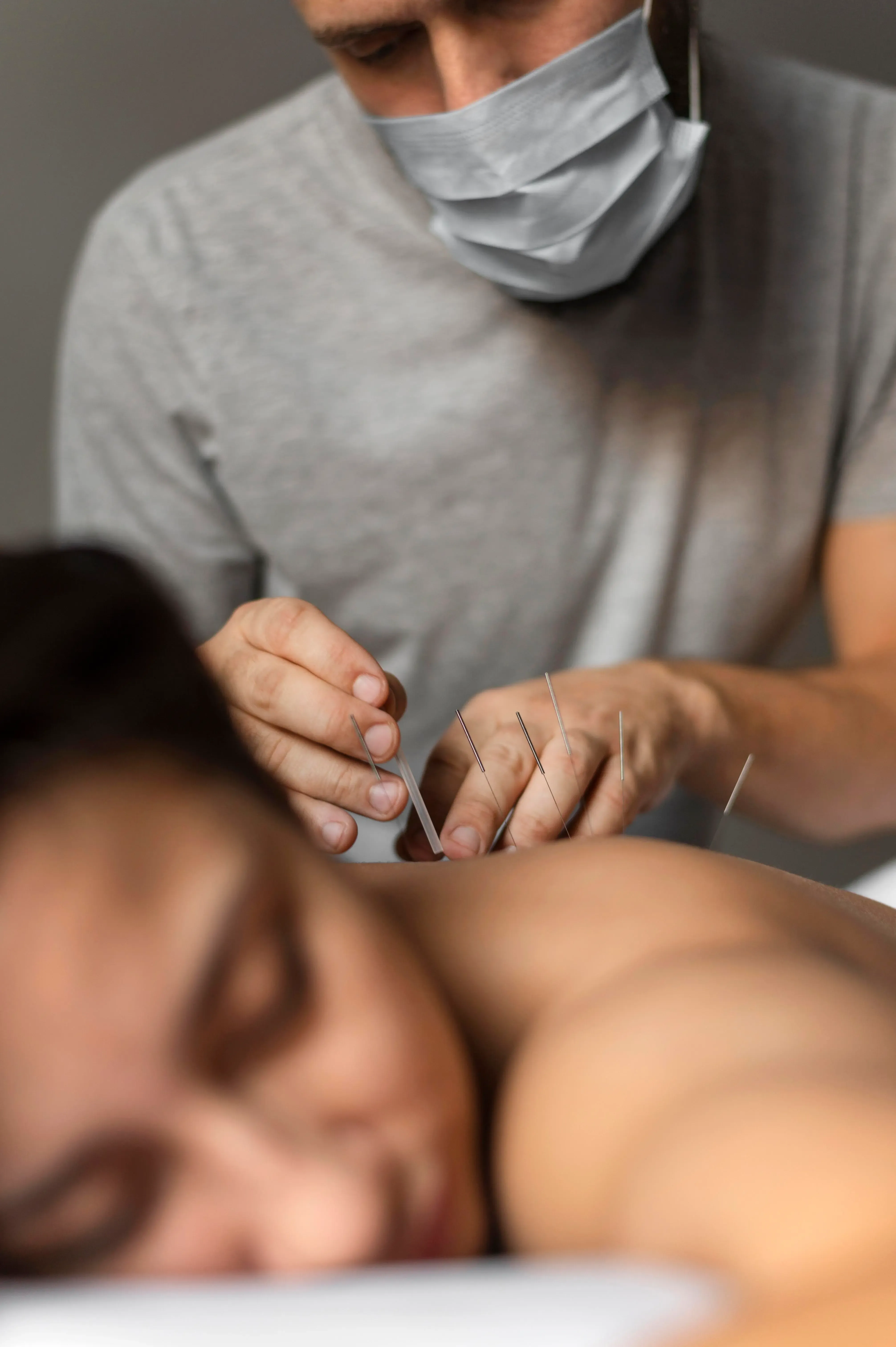 Acupuncture pain relief results at Spine-Ability Apollo Beach FL
