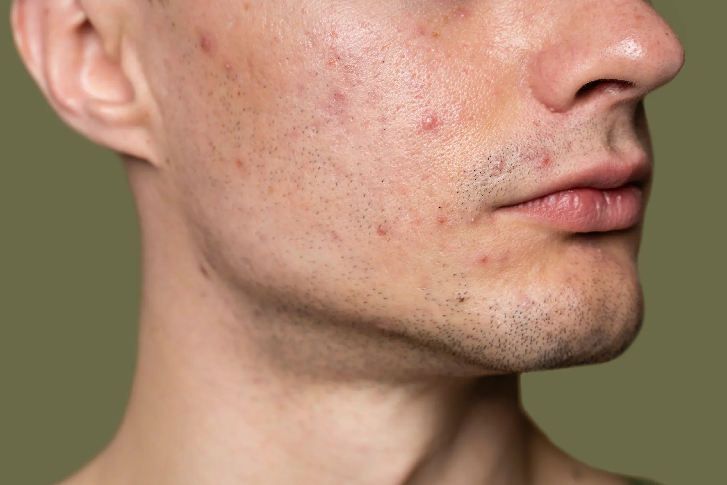 Abstract background representing acne treatment areas at Mint Aesthetics & Skin Indianapolis