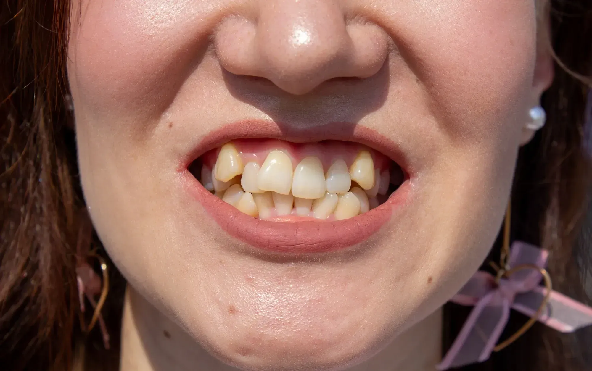 Diagram showing crowded teeth caused by small jaw size