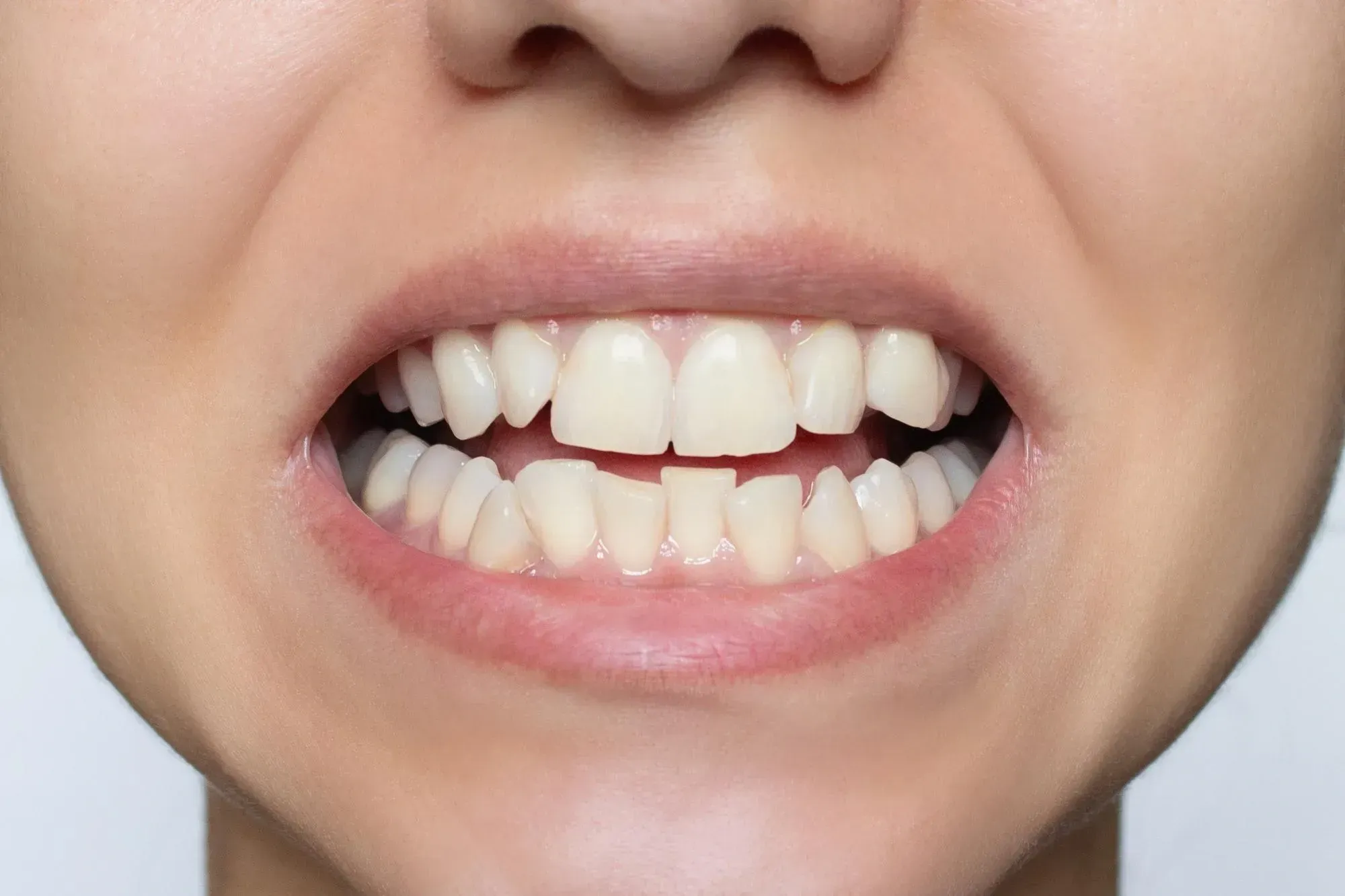 Adult patient consulting with dentist about straightening options