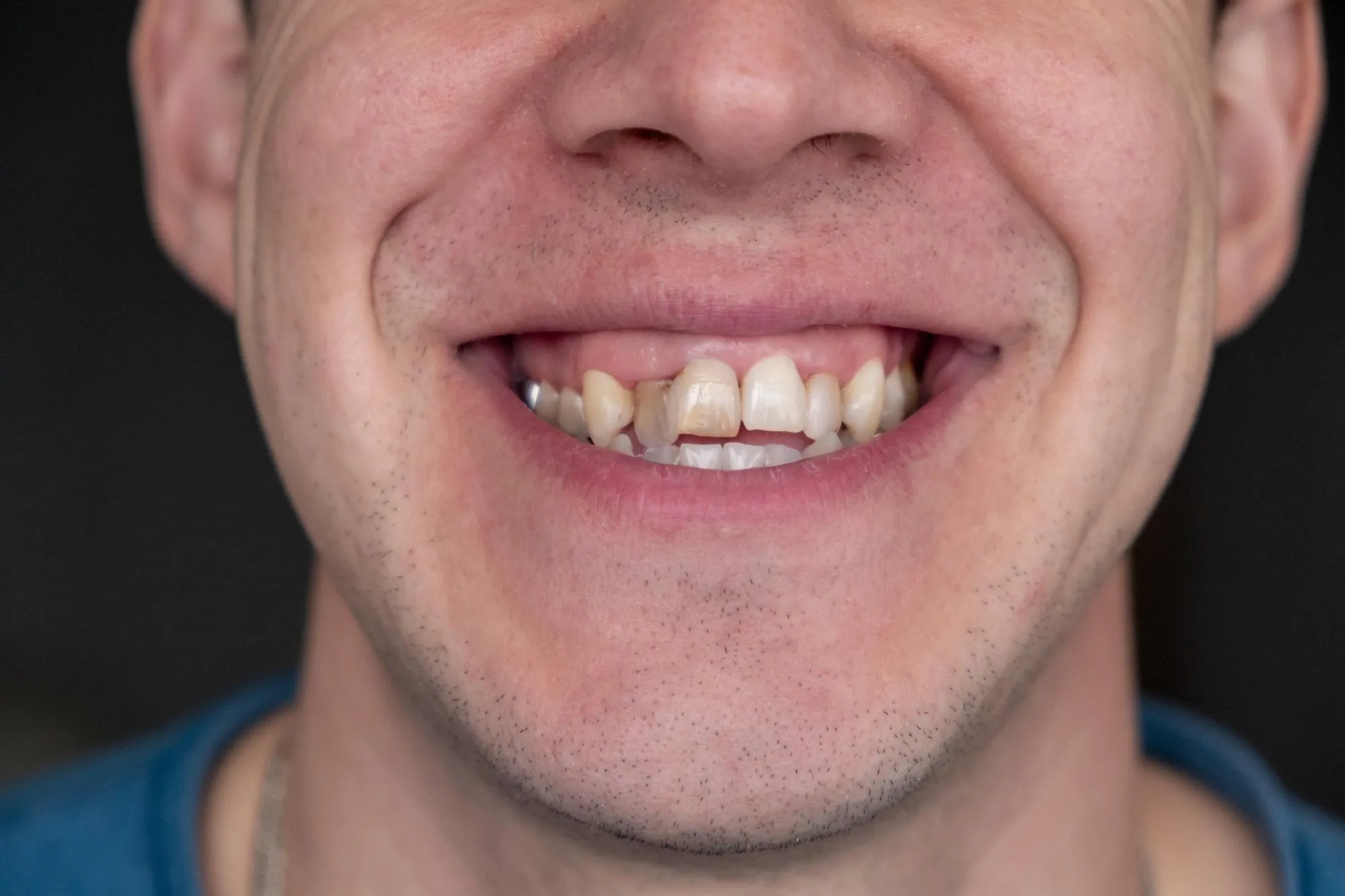 Patient looking in mirror noticing crooked or misaligned teeth
