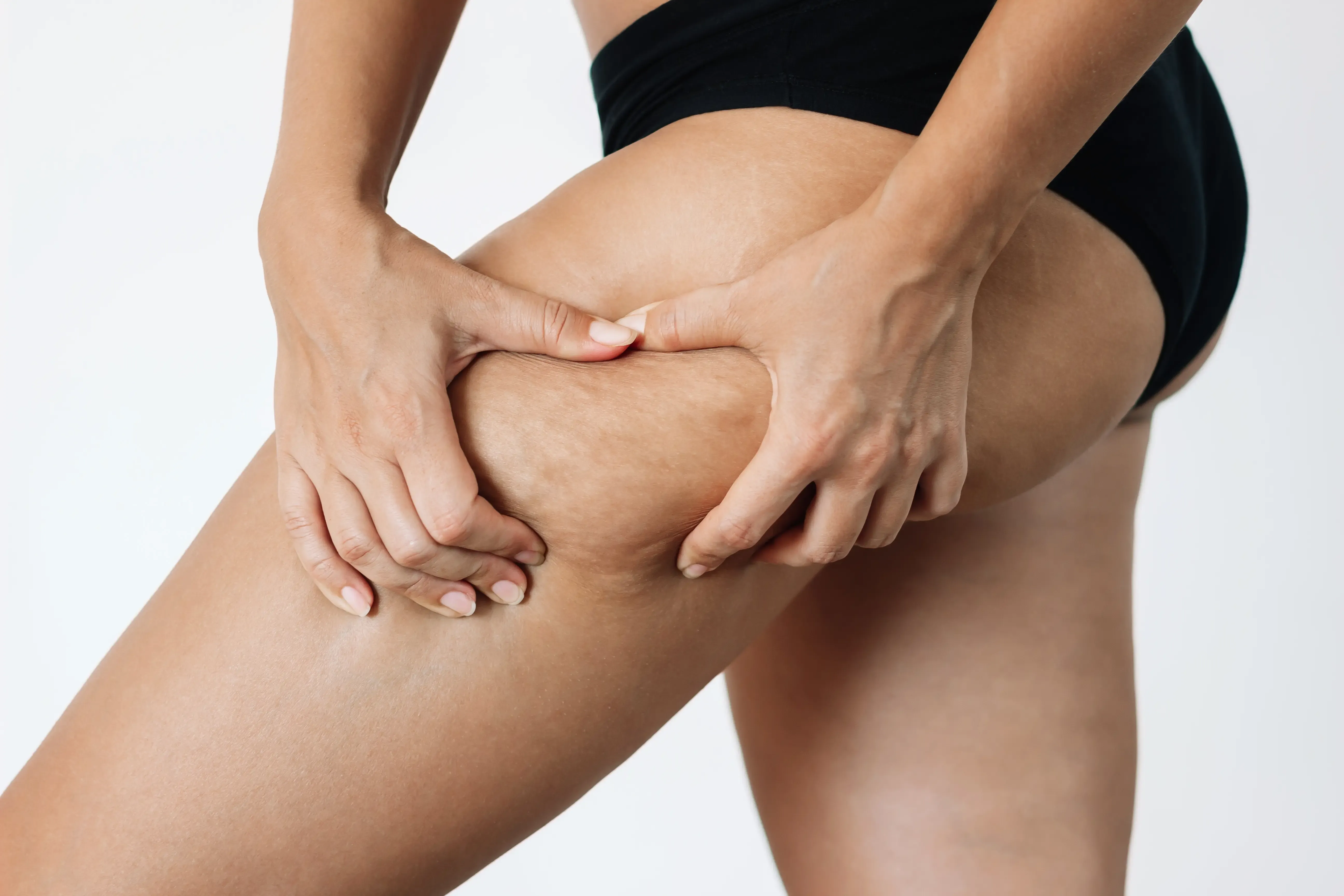 Lifestyle factors influencing cellulite at Heritage Wellness & Med Spa Crescent Springs