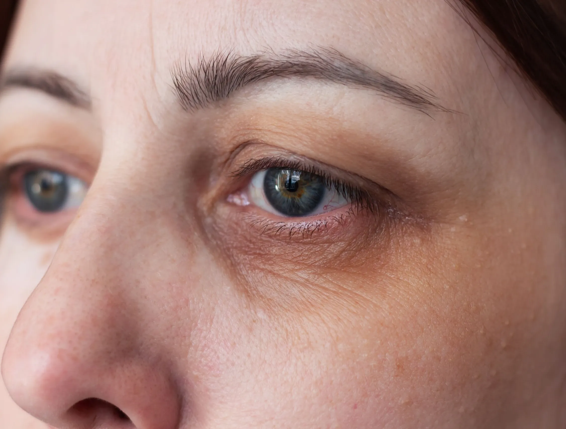 Patient concerned about under-eye shadows at Dental World Longwood Florida