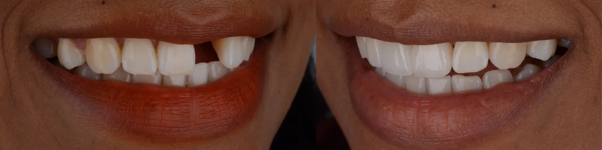 Dental Bridges - Before and After